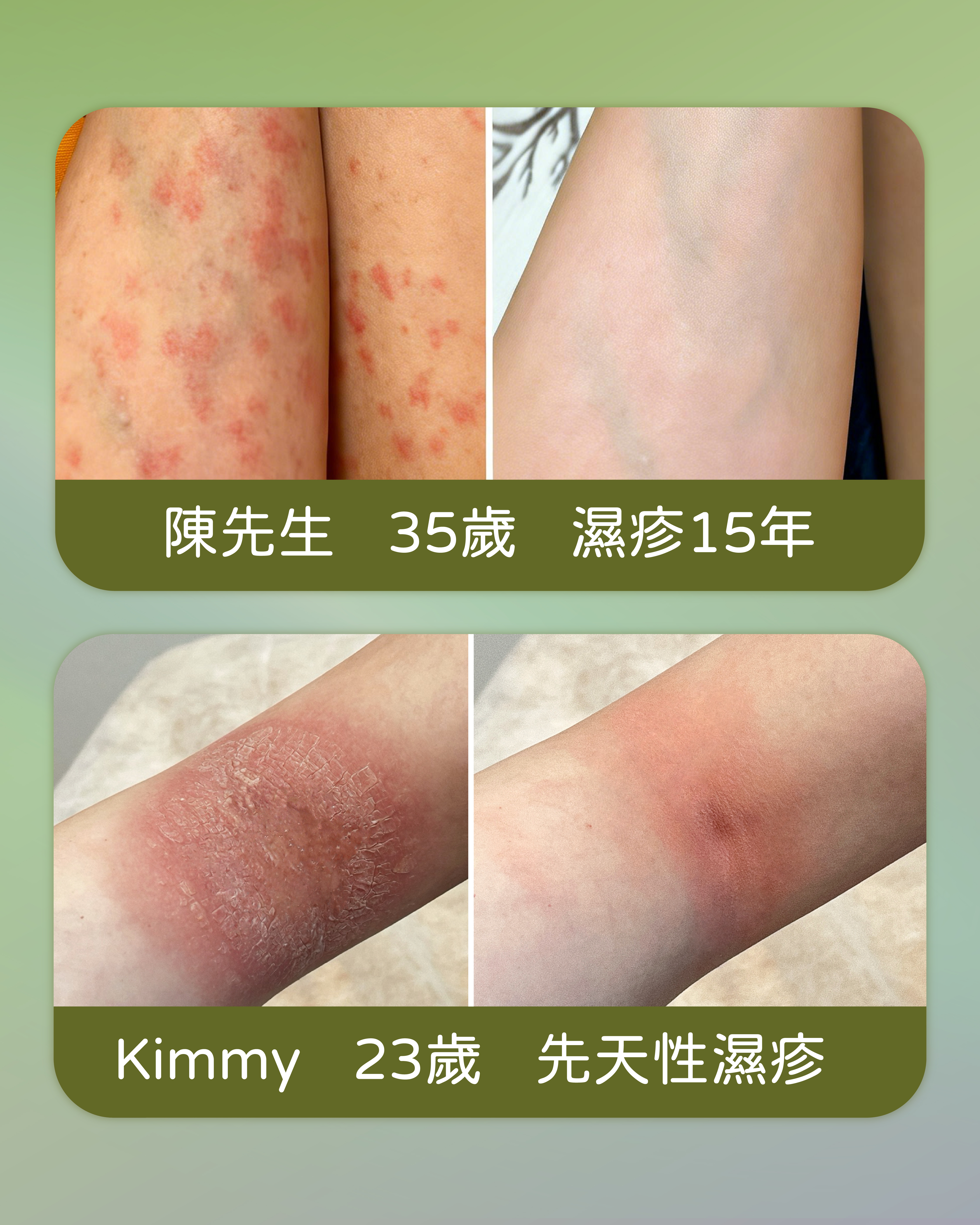 濕疹個案分享 — 陳先生、Kimmy