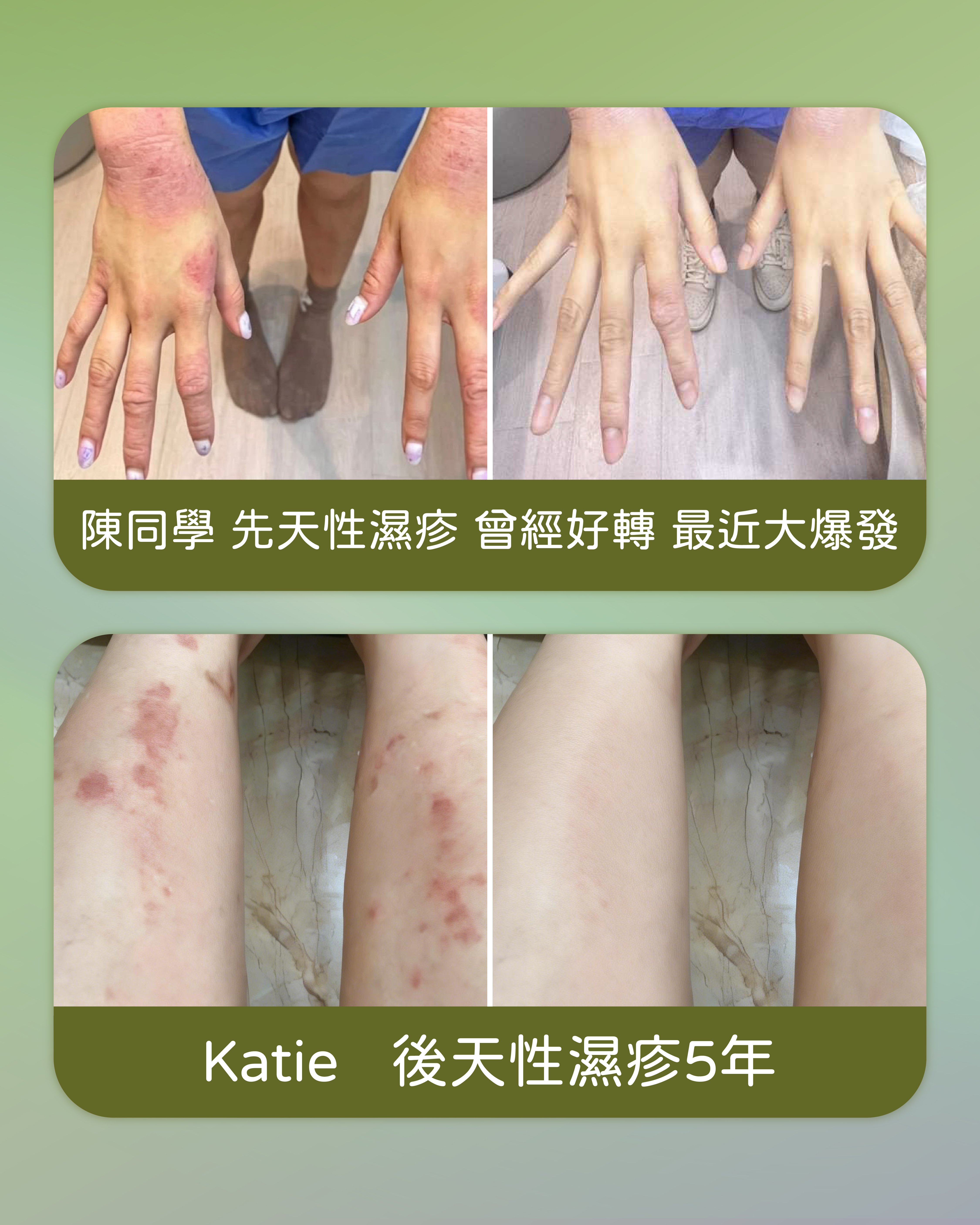 濕疹個案分享 — Anna、Lulu