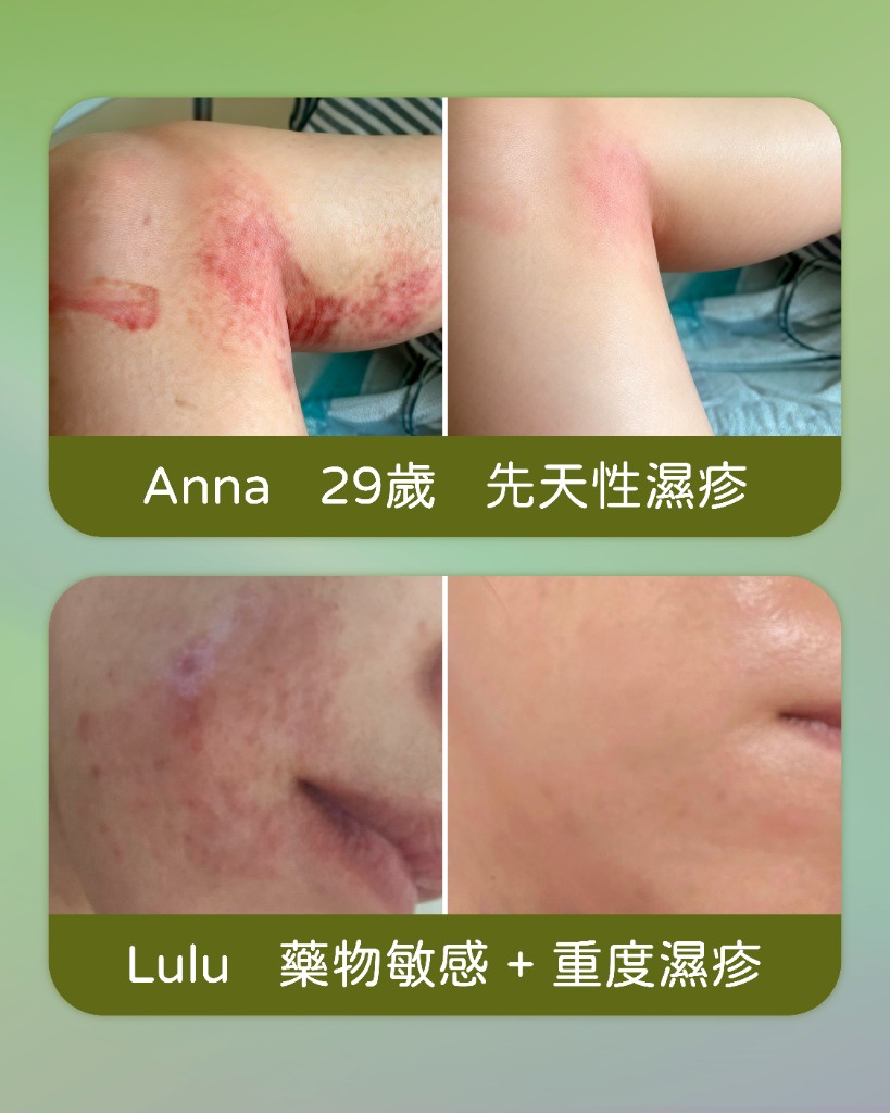 濕疹個案分享 — Anna、Lulu
