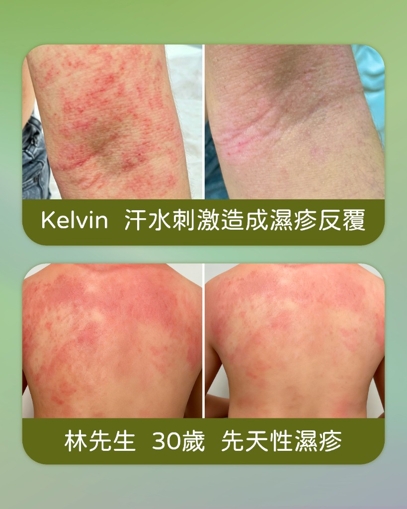 濕疹個案分享 — Kelvin、林先生